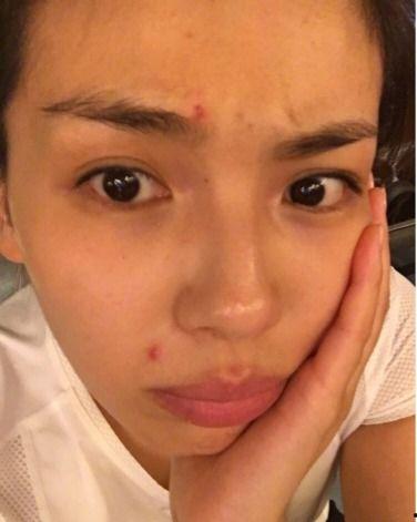 爆痘的明星,揭秘娱乐圈抗痘明星的护肤秘籍